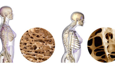 Osteoporosis y calcio