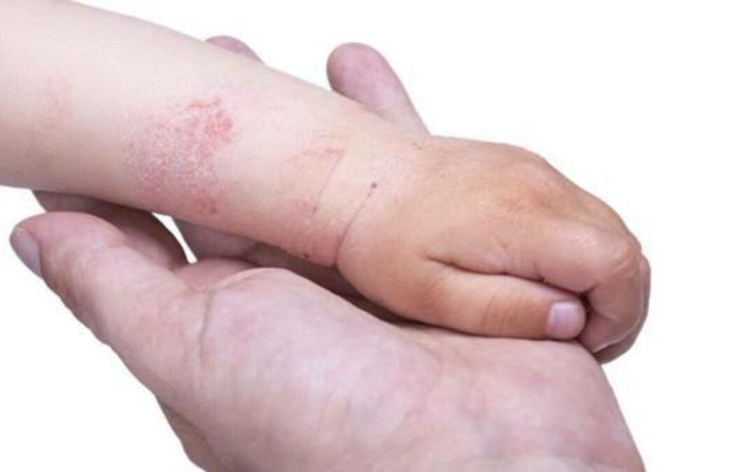 1. Dermatitis atópica