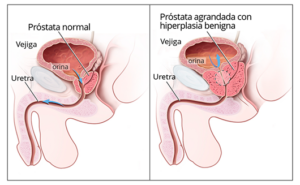 Hiperplasia benigna de próstata