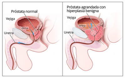 Hiperplasia Benigna de Próstata